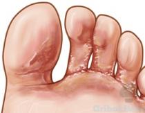 Athlete's foot - forms of the disease (inguinal, athlete's foot), causes and symptoms, photos
