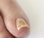 Thick toenails what to do Why are toenails hard