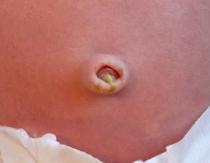 Why does a newborn’s navel bleed and become wet, what should I do?